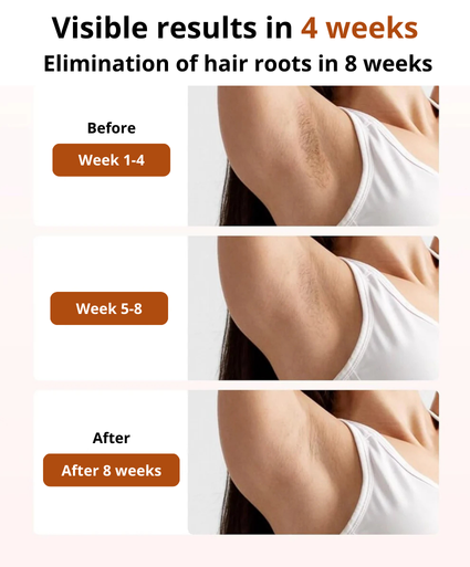 Pulsed Light Hair Removal Device – Permanent Hair Removal at Home